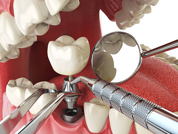Best Emergency Tooth Extraction in Franklin Furnace, OH